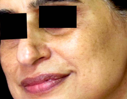 Pigmentation
