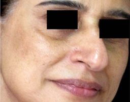 Pigmentation