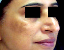 Pigmentation