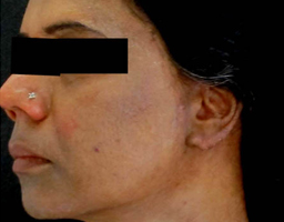 Pigmentation