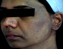 Pigmentation