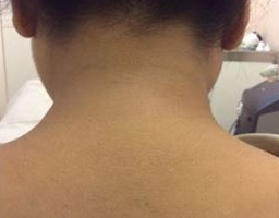 Pigmentation