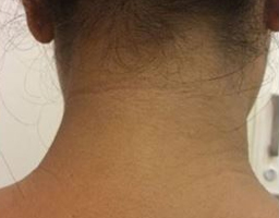 Pigmentation