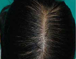 PRP Therapy