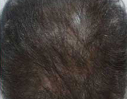 PRP Therapy