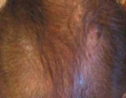 PRP Therapy