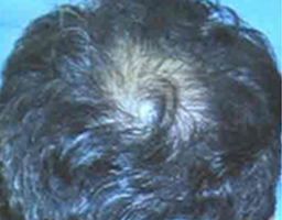 PRP Therapy
