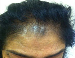 PRP Therapy