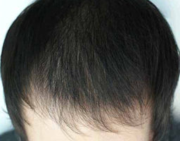 PRP Therapy