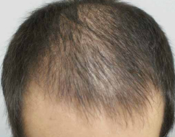 PRP Therapy