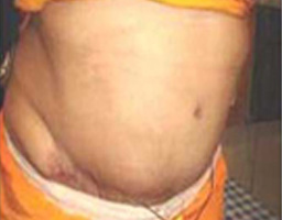 Tummy Tuck