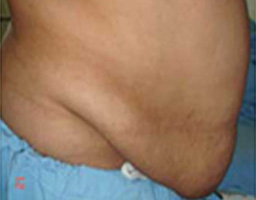 Tummy Tuck