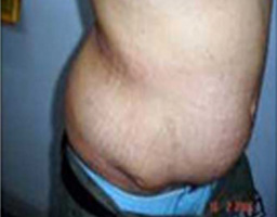 Tummy Tuck