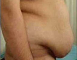 Tummy Tuck