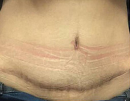 Tummy Tuck