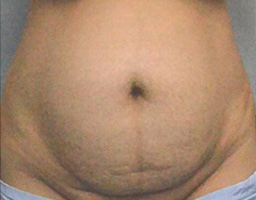 Tummy Tuck