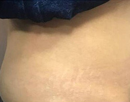 Tummy Tuck