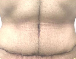 Tummy Tuck