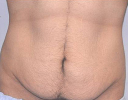 Tummy Tuck