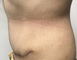 Tummy Tuck
