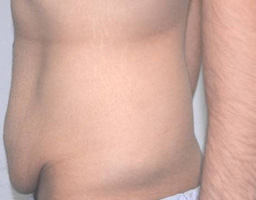 Tummy Tuck