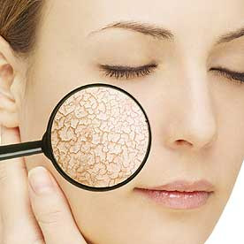 Acne Scars Treatment