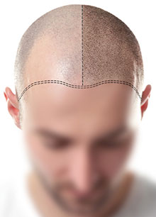 Hair Transplant