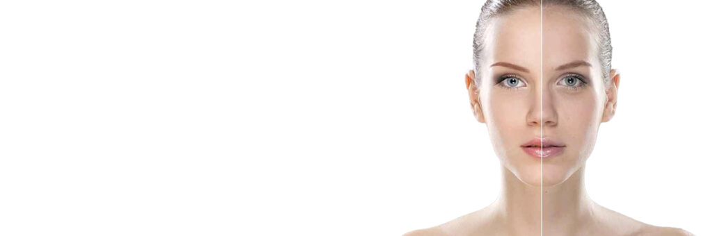 Acne Scars Treatment in Delhi