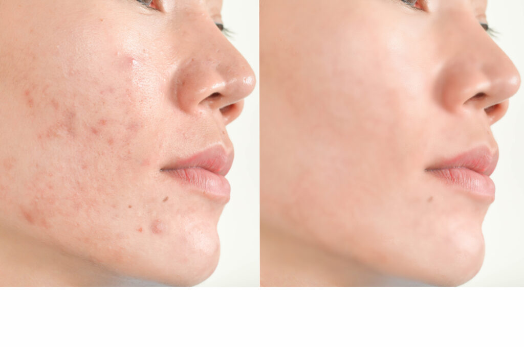 Acne scars and pores. Black spots, wrinkles and skin problems  F